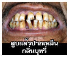 Thailand 2006 Health Effects mouth - bad breath, gross